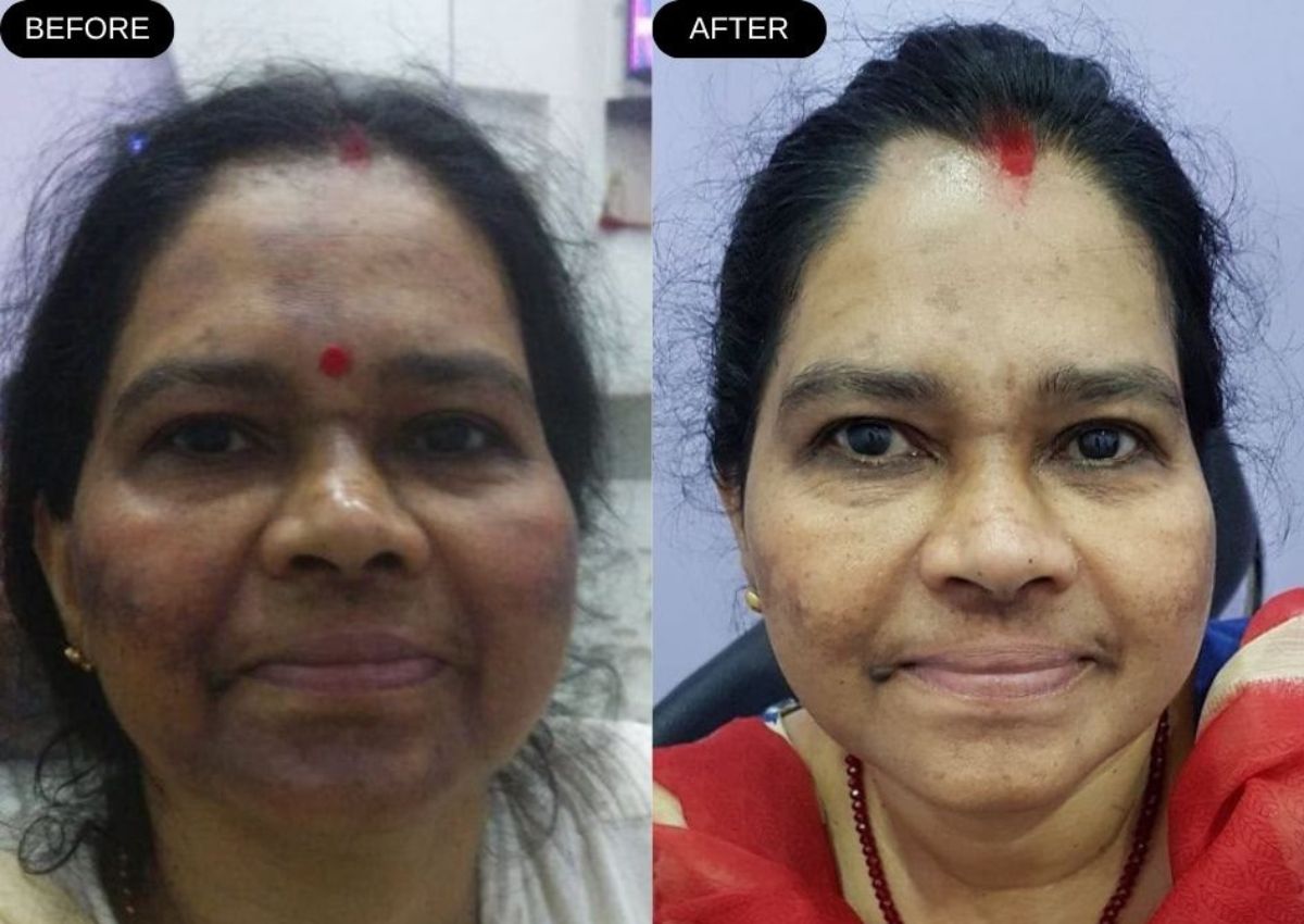 Before and after skin treatment