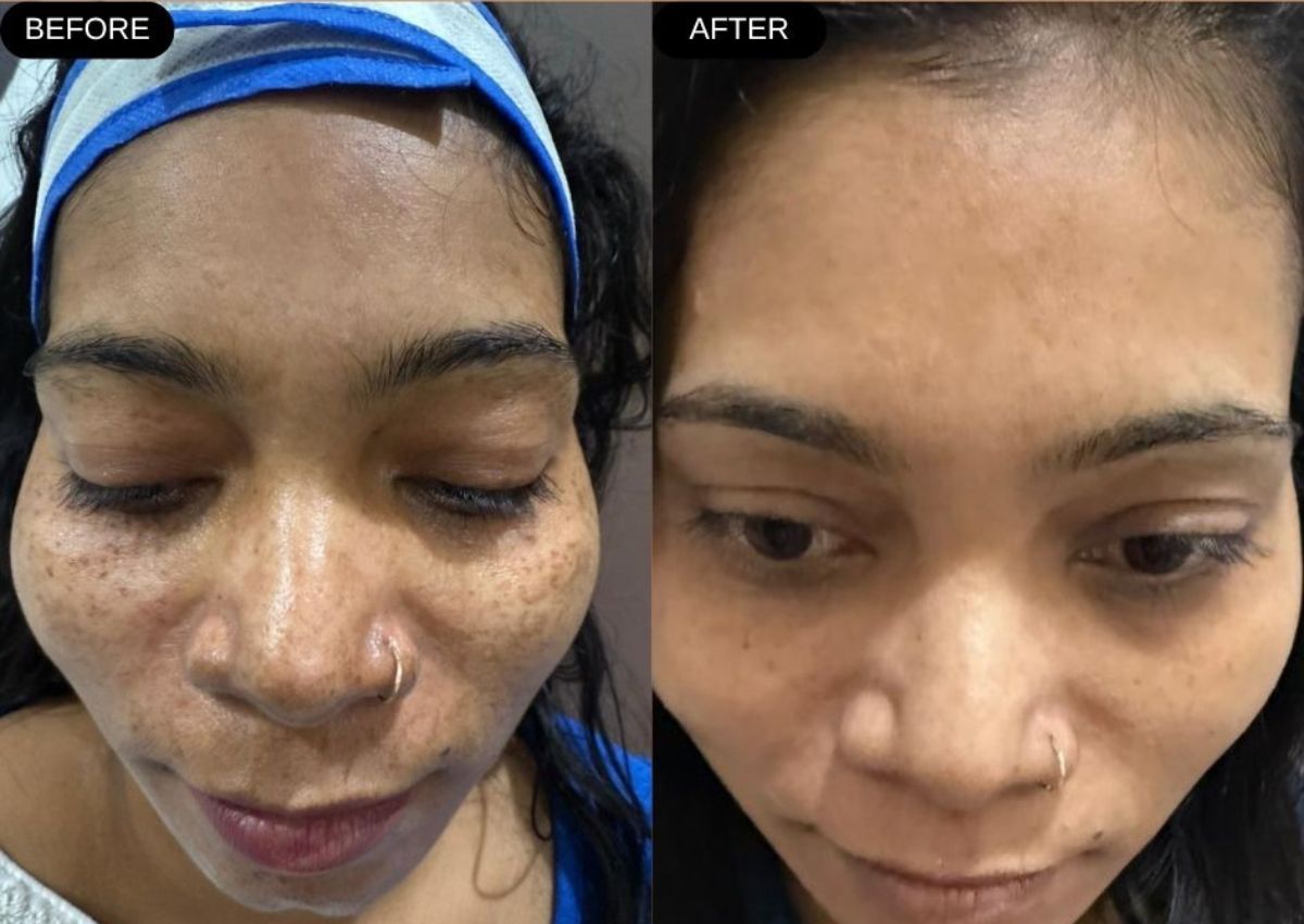 Before and after skin treatment