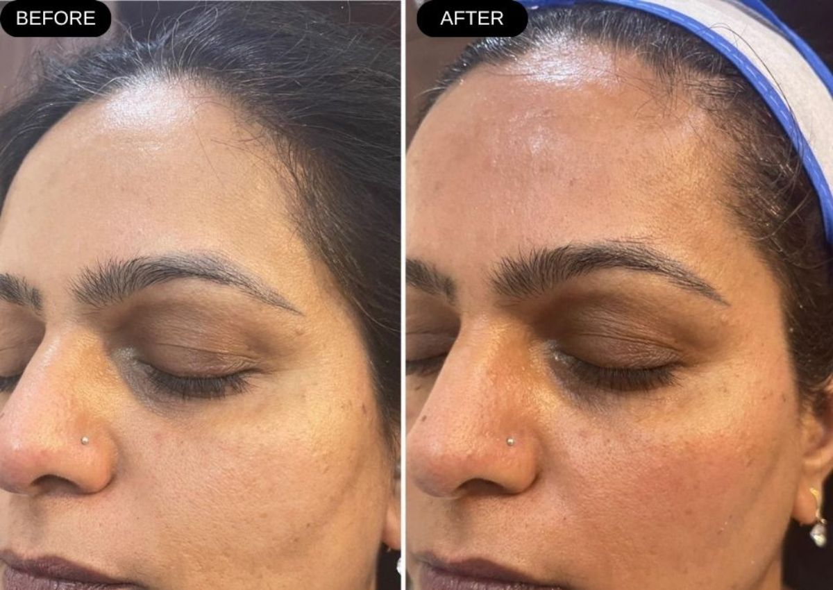 Before and after skin treatment